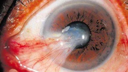 眼睛里長了小翅膀怎么辦？警惕視力殺手翼狀胬肉！